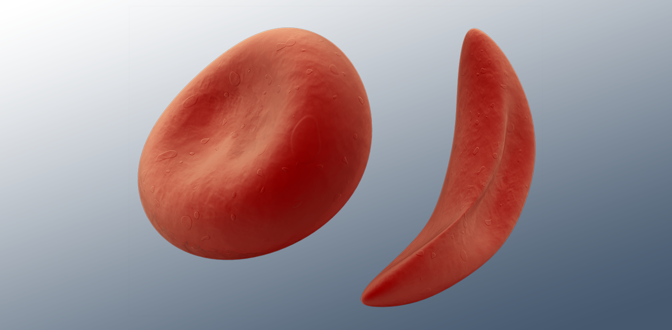 Illustration of enlarged view of regular cell and a sickle cell